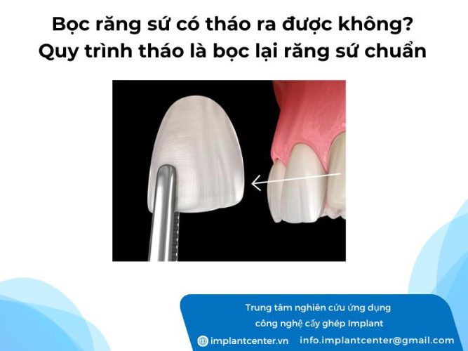 Bọc răng sứ có tháo ra được không? Quy trình tháo là bọc lại răng sứ chuẩn