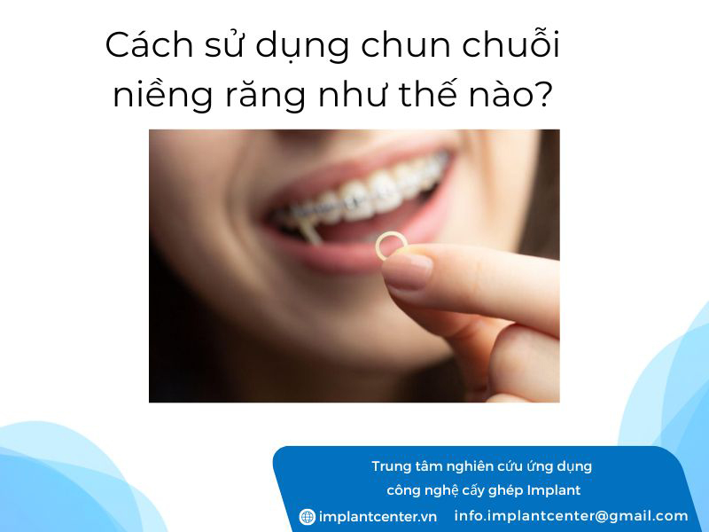 Cách sử dụng chun chuỗi niềng răng như thế nào?