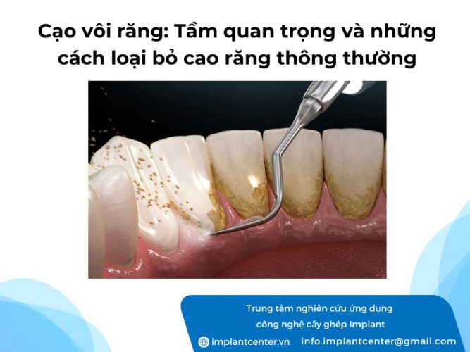 Cạo vôi răng: Tầm quan trọng và những cách loại bỏ cao răng thông thường