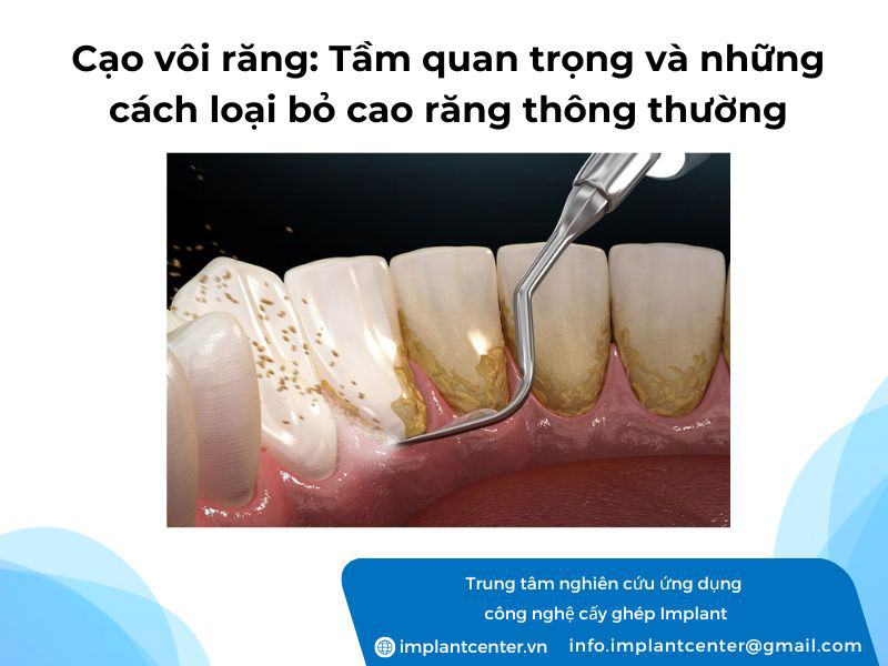 Cạo vôi răng: Tầm quan trọng và những cách loại bỏ cao răng thông thường