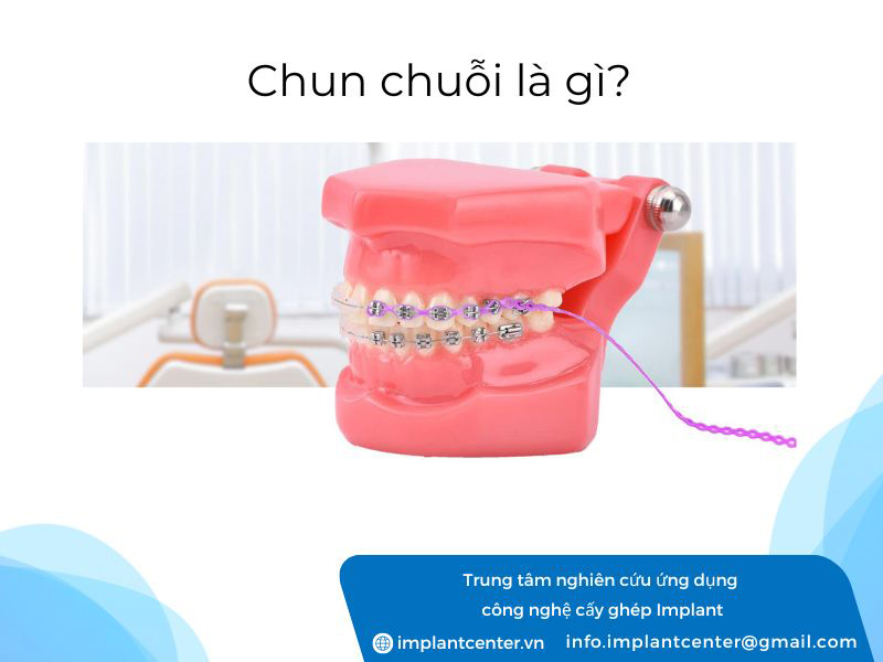 Chun chuỗi là gì?