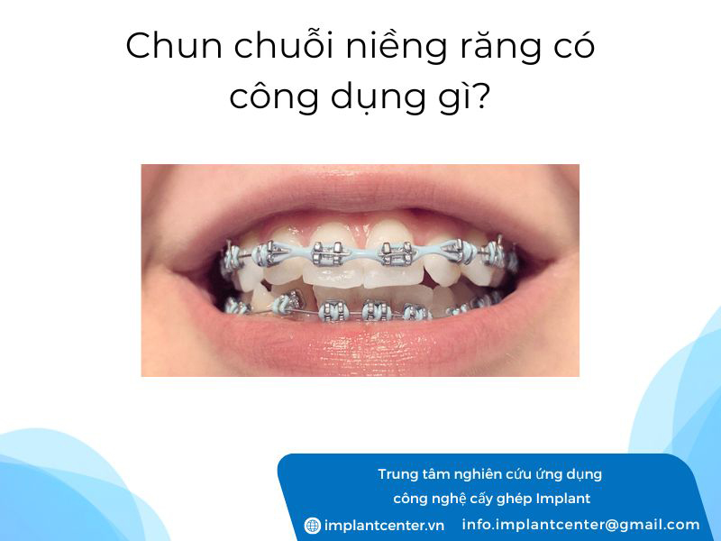 Chun chuỗi niềng răng có công dụng gì?