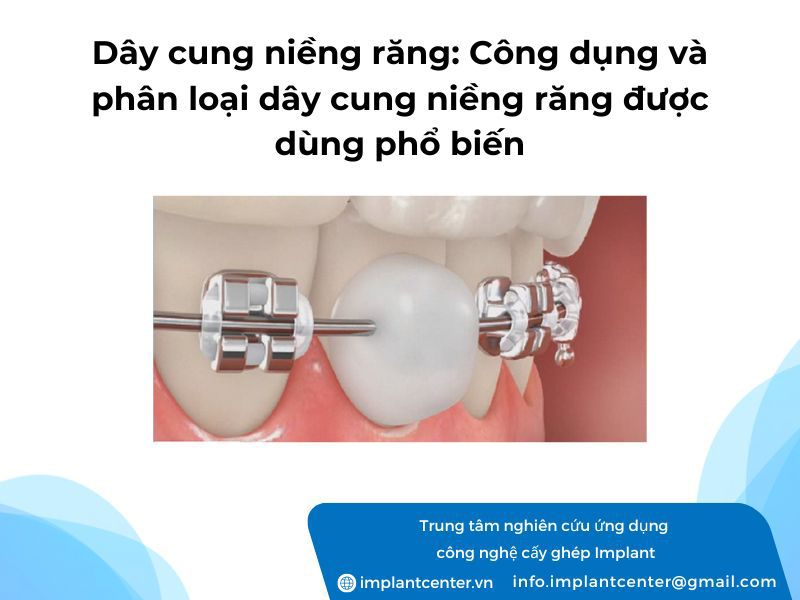 Dây cung niềng răng: công dụng và phân loại dây cung niềng răng được dùng phổ biến