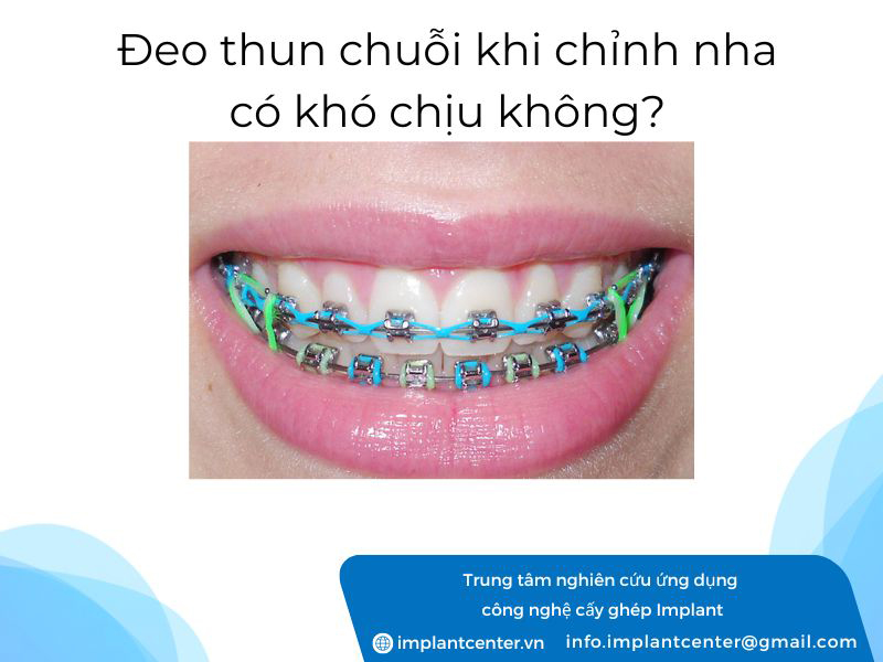 Đeo thun chuỗi khi chỉnh nha có khó chịu không?