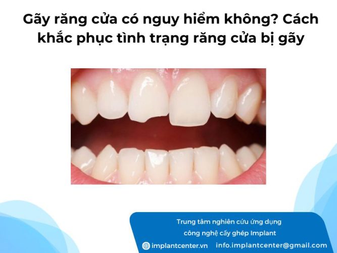 Gãy răng cửa có nguy hiểm không? Cách khắc phục tình trạng răng cửa bị gãy