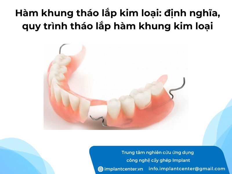 Hàm khung tháo lắp kim loại định nghĩa quy trình tháo lắp hàm khung kim loại