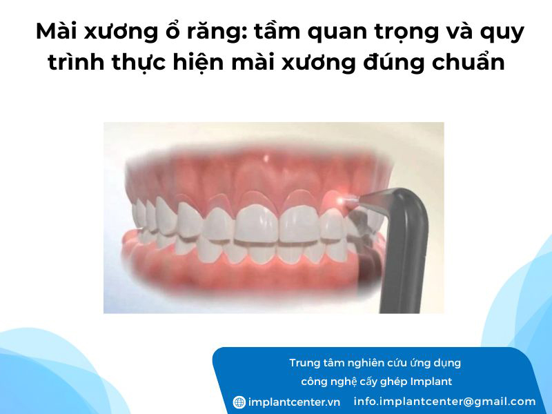 Mài xương ổ răng tầm quan trọng và quy trình thực hiện mài xương đúng chuẩn nha khoa