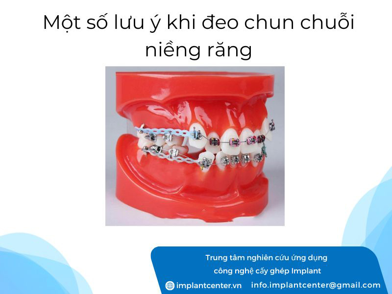 Một số lưu ý khi đeo chun chuỗi niềng răng