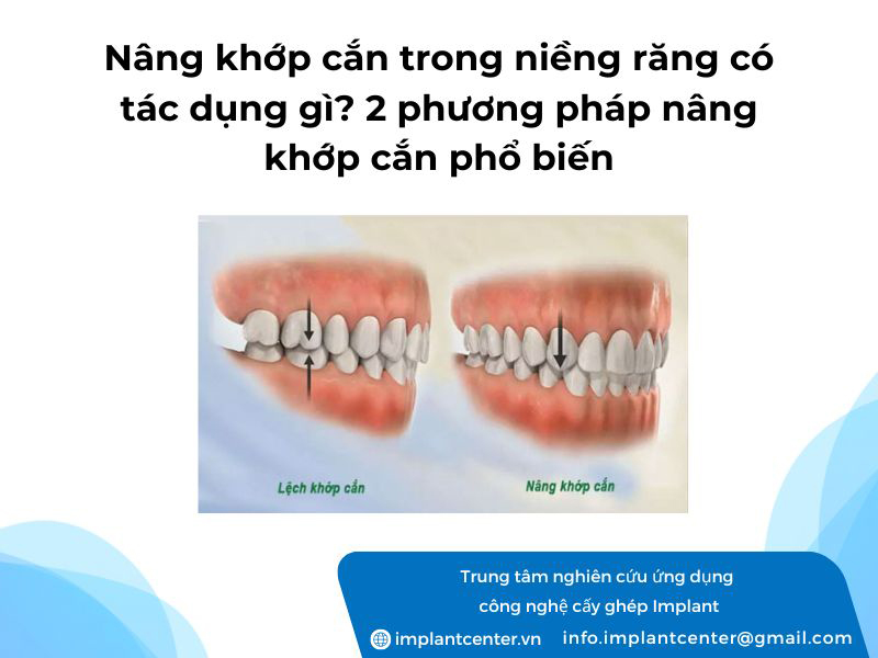 Nâng khớp cắn trong nièng răng có tác dụng gì? 2 phương pháp nâng khớp cắn phổ biến