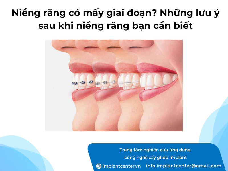 Niềng răng có mấy giai đoạn? Những lưu ý sau khi niềng răng bạn cần biết