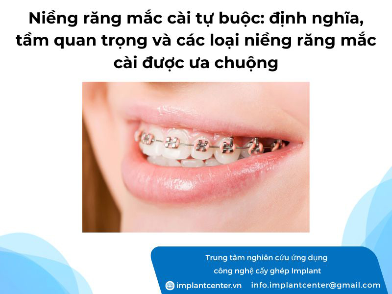 Niềng răng mắc cài tự buộc: định nghĩa, tầm quant rọng và các loại niềng răng mắc cài tự buộc