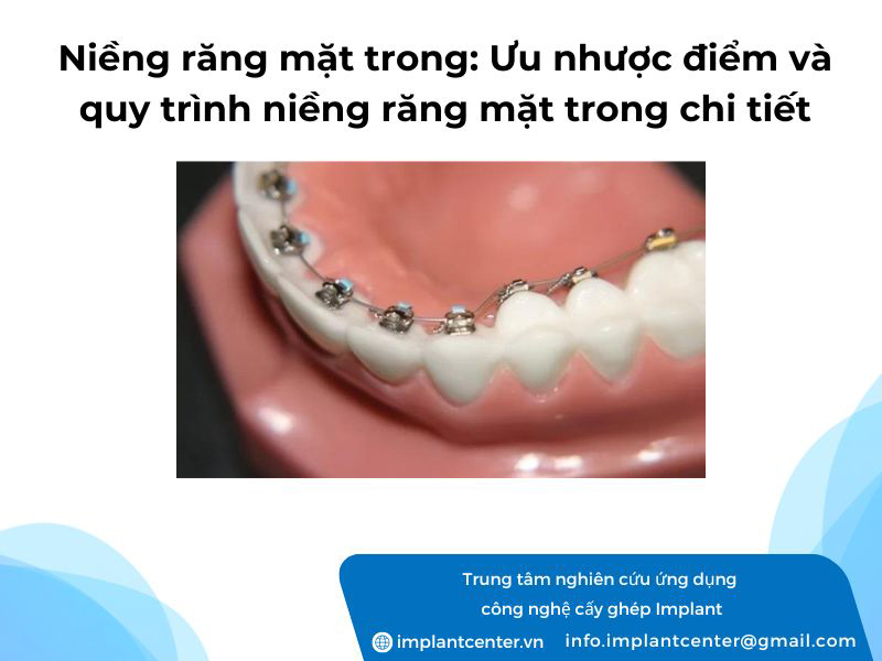 Niềng răng mặt trong: Ưu nhược điểm và quy trình niềng răng mặt trong chi tiết