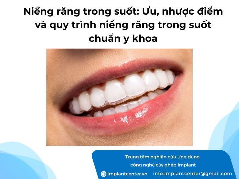 Niềng răng trong suốt: ưu nhược điểm và quy trình niềng răng trong suốt chuẩn y khoa
