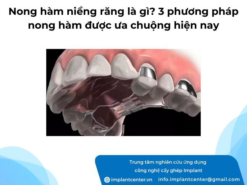 Nong hàm niềng răng là gì? 3 phương pháp nong hàm được ưa chuộng hiện nay