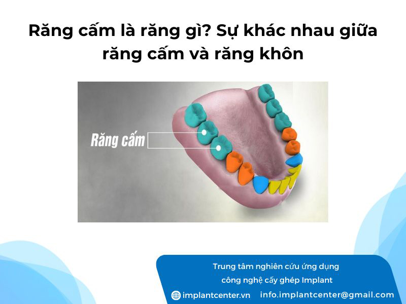 Răng cấm là răng gì? Sự khác nhau giữa răng cấm và răng khôn