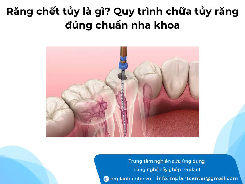 Răng chết tuỷ là gì? Quy trình chữa tuỷ răng đúng chuẩn nha khoa