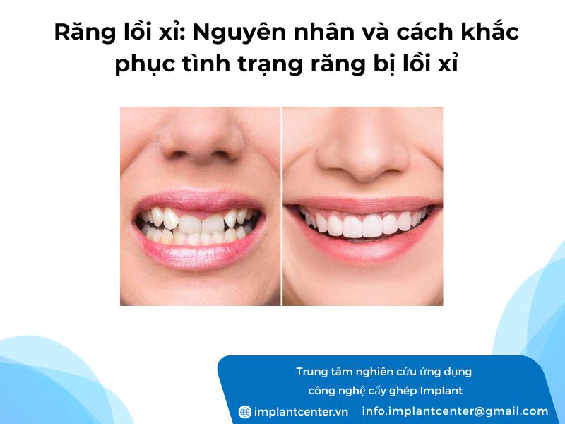 Răng bị lồi xỉ: Nguyên nhân và cách khắc phục tình trạng răng bị lồi xỉ