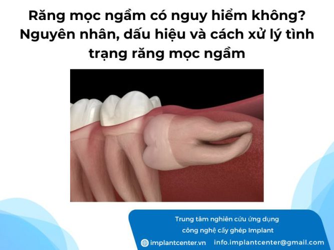 Răng mọc ngầm có nguy hiểm không? Nguyên nhân, dấu hiệu và cách xử lý tình trạng răng mọc ngầm