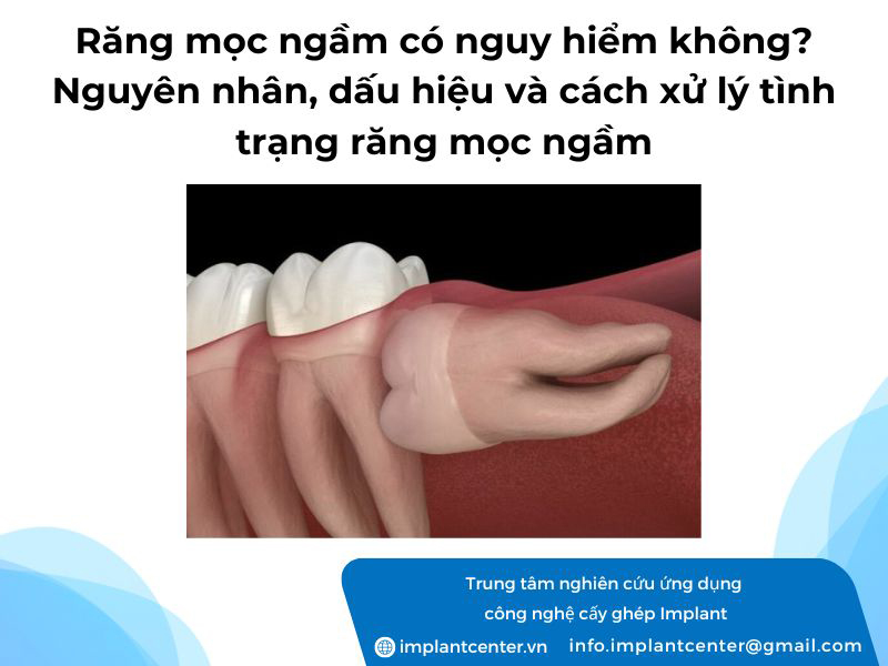 Răng mọc ngầm có nguy hiểm không? Nguyên nhân, dấu hiệu và cách xử lý tình trạng răng mọc ngầm
