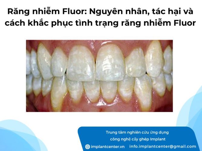 Răng nhiễm Fluor: nguyên nhân, tác hại và cách khắc phục tình trạng răng nhiễm Fluor