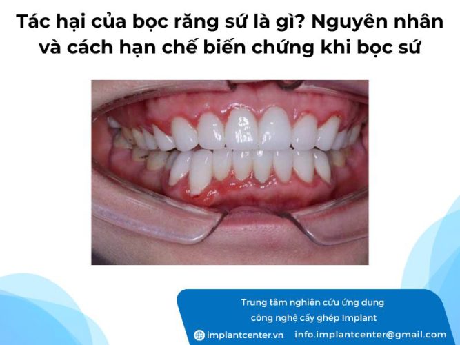 Tác hại của bọc răng sứ là gì? Nguyên nhân và cách hạn chế biến chứng khi bọc sứ