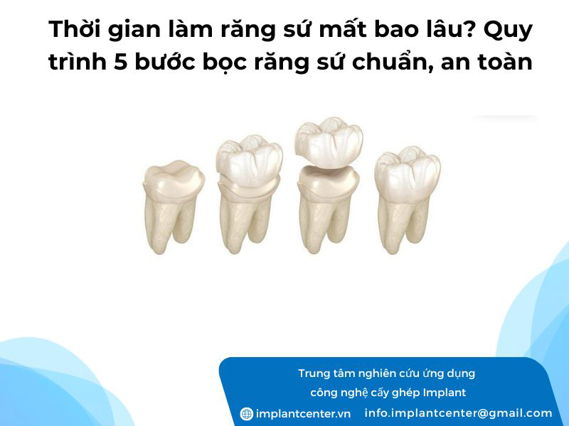 Thời gian làm răng sứ mất bao lâu? Quy trình 5 bước bọc răng sứ chuẩn, an toàn