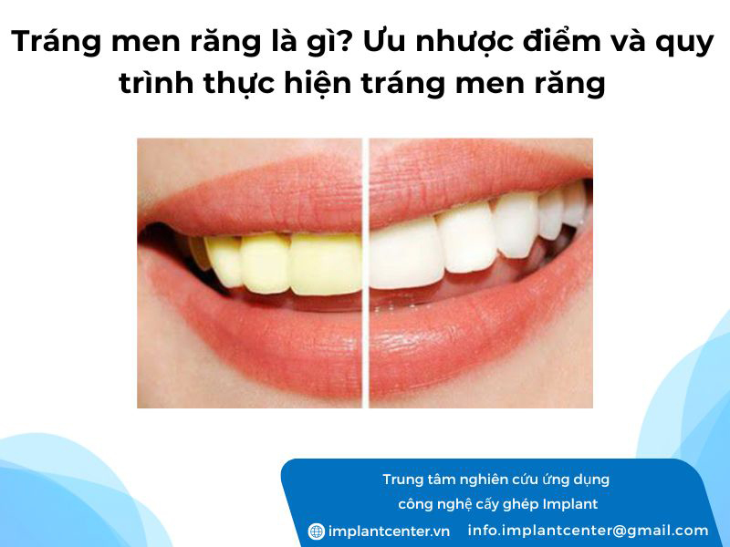 Tráng men răng là gì? Ưu nhược điểm và quy trình thực hiện tráng men răng