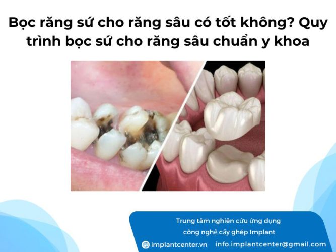 Bọc răng sứ cho răng sâu có tốt không? Quy trình bọc sứ cho răng sâu chuẩn y khoa