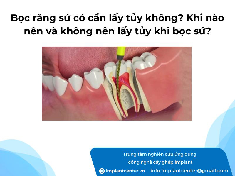 Bọc răng sứ có cần lấy tủy không? Khi nào nên và không nên lấy tủy khi bọc sứ?