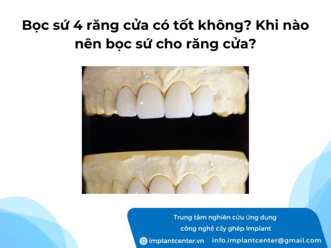 Bọc sứ 4 răng cửa có tốt không? Khi nào nên bọc sứ cho răng cửa?