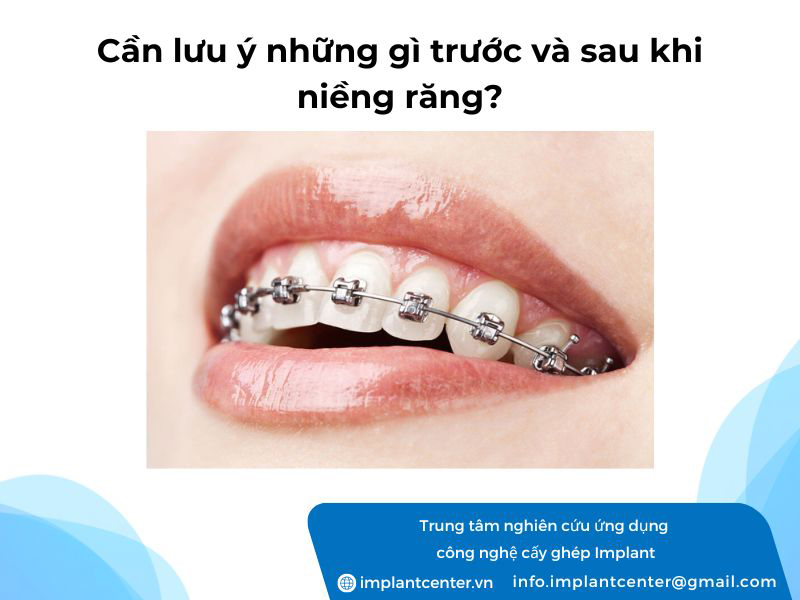 Cần lưu ý những gì trước và sau khi niềng răng?