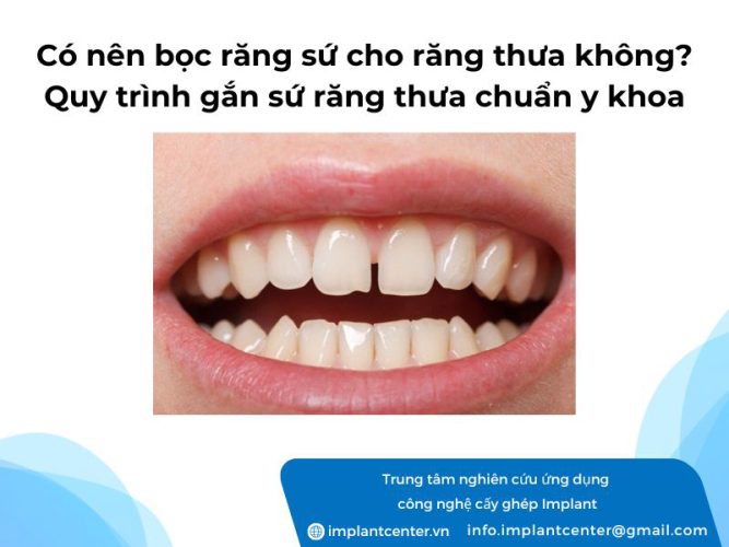 Có nên bọc răng sứ cho răng thưa không? Quy trình gắn sứ răng thưa chuẩn y khoa