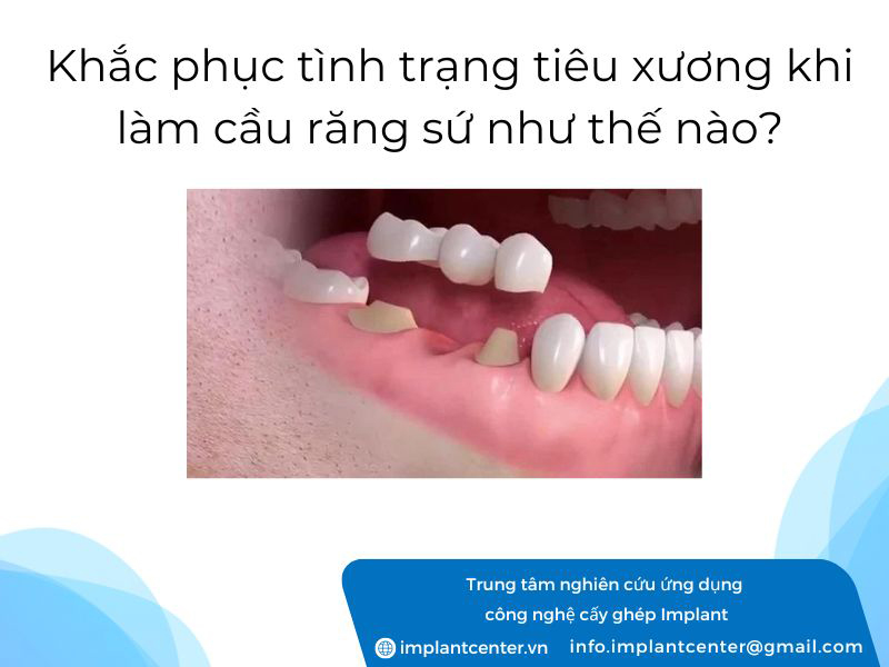 Khắc phục tình trạng tiêu xương khi làm cầu răng sứ như thế nào?
