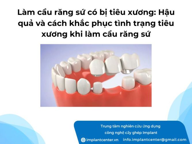 Làm cầu răng sứ có bị tiêu xương: Hậu quả và cách khắc phục tình trạng tiêu xương khi làm cầu răng sứ