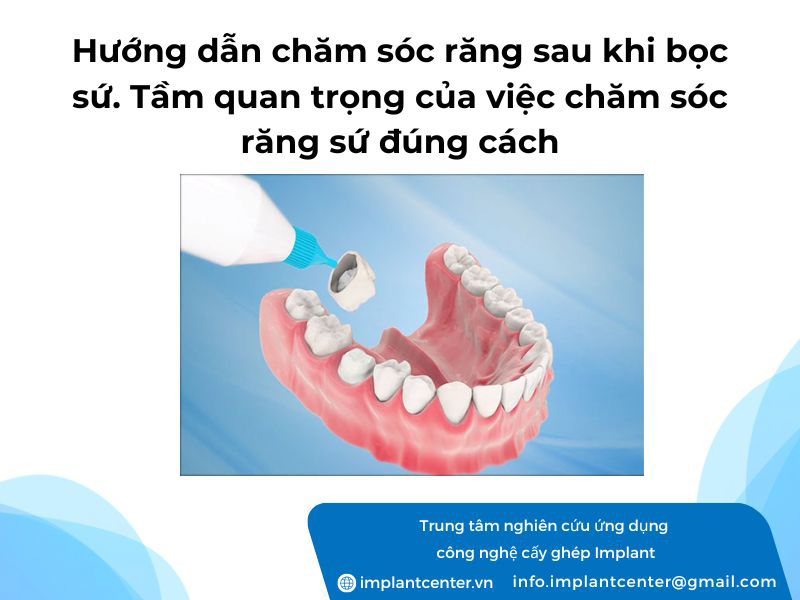 Hướng dẫn chăm sóc răng sau khi bọc sứ. Tầm quan trọng của việc chăm sóc răng sứ đúng cách