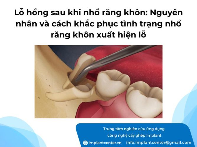 Lỗ hổng sau khi nhổ răng khôn: Nguyên nhân và cách khắc phục tình trạng nhổ răng khôn xuất hiện lỗ