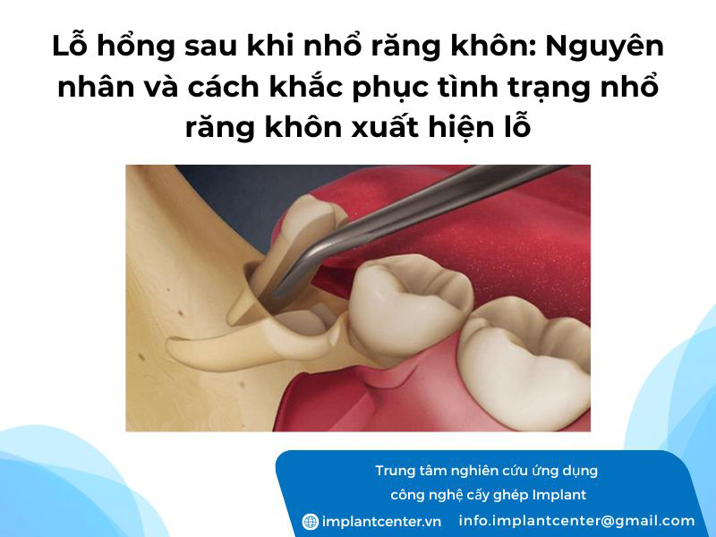 Lỗ hổng sau khi nhổ răng khôn: Nguyên nhân và cách khắc phục tình trạng nhổ răng khôn xuất hiện lỗ