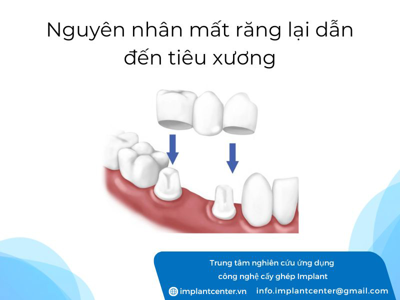 Nguyên nhân mất răng lại dẫn đến tiêu xương
