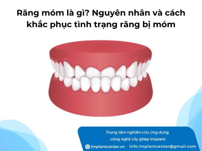 Răng móm là gì? Nguyên nhân và cách khắc phục tình trạng răng bị móm