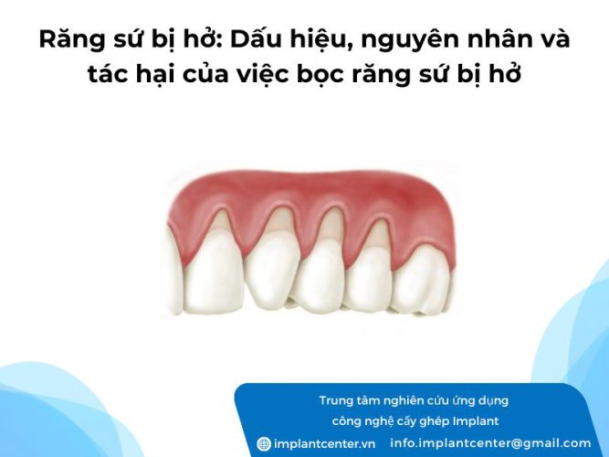 Răng sứ bị hở: Dấu hiệu, nguyên nhân và tác hại của việc bọc răng sứ bị hở