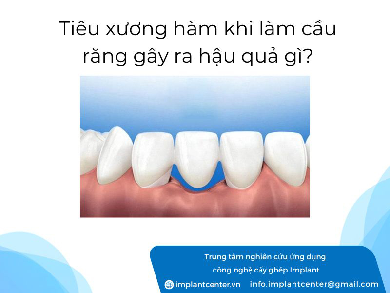 Tiêu xương hàm khi làm cầu răng gây ra hậu quả gì?