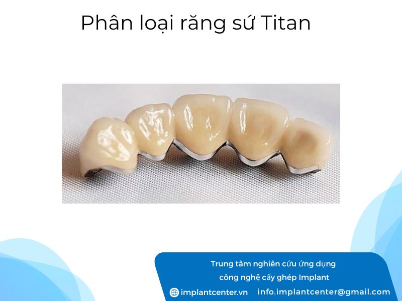 Phan-loai-rang-su-Titan