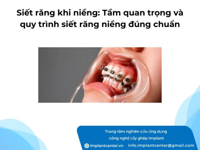 Siet-rang-khi-nieng-Tam-quan-trong-va-quy-trinh-siet-rang-nieng-dung-chuan