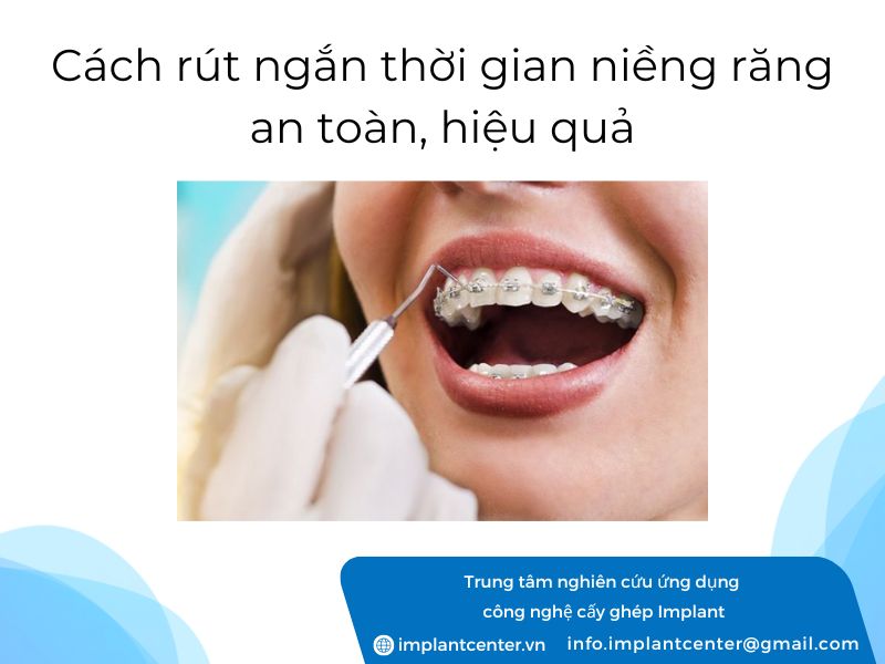 Cach-rut-ngan-thoi-gian-nieng-rang-an-toan-hieu-qua