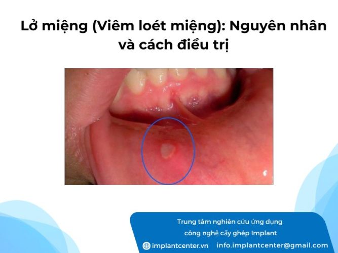 Lo-mieng-Viem-loet-mieng-Nguyen-nhan-va-cach-dieu-tri