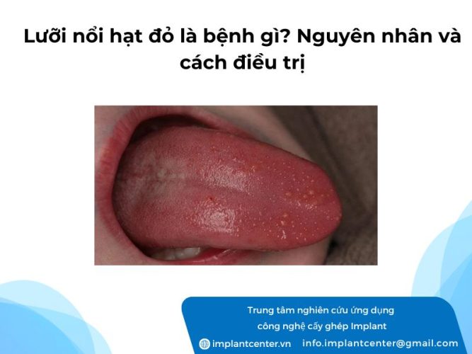 Luoi-noi-hat-do-la-benh-gi-Nguyen-nhan-va-cach-dieu-tri