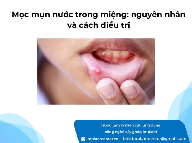 Moc-mun-nuoc-trong-mieng-nguyen-nhan-va-cach-dieu-tri