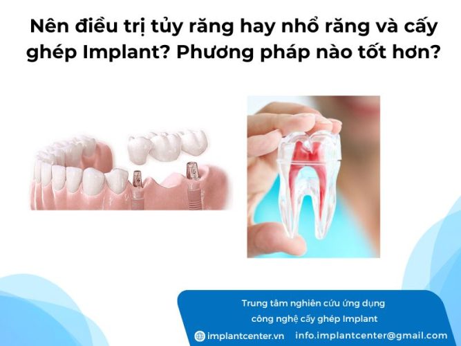 Nen-dieu-tri-tuy-rang-hay-nho-rang-va-cay-ghep-Implant-Phuong-phap-nao-tot-hon