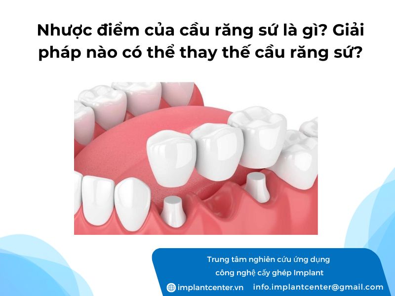 Nhuoc-diem-cua-cau-rang-su