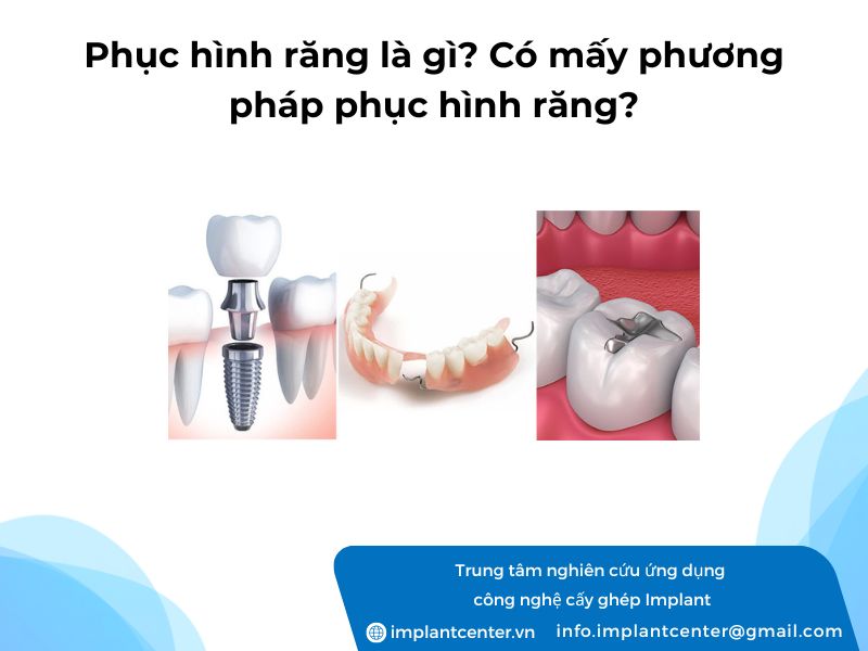 Phuc-hinh-rang-la-gi-Co-may-phuong-phap-phuc-hinh-rang